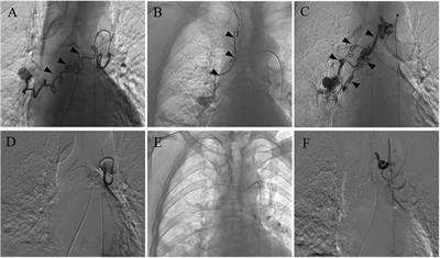 Case Report: Ectopic pulmonary embolism as a complication of bronchial artery embolization